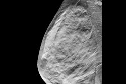 Breast Tomosynthesis Digital 400