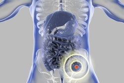 Colon Cancer