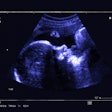 Fetal Ultrasound
