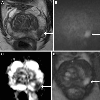 Multiparametric MRI in a 68-year-old male participant with a prostate-specific antigen level of 9.49 ng/mL. (A) Axial T2-weighted fast spin-echo MRI scan (repetition time msec/echo time msec, 3820/97) shows a 13-mm Prostate Imaging Reporting and Data System 4 nodule in the left midgland posterolateral peripheral zone (arrow). (B) Diffusion-weighted image (b = 1600 sec/mm2) and (C) corresponding apparent diffusion coefficient (ADC) map show marked restricted diffusion at the site (arrows), with an ADC of 515 µm2/sec. (D) Dynamic contrast-enhanced image shows focal early enhancement at the tumor site (arrow). Targeted biopsy revealed grade group 3 prostate cancer (PCa) with cribriform/intraductal histologic features. The participant underwent radiation therapy for treatment of PCa. Images and caption courtesy of Radiology.