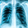 X Ray Chest Lungs 400b