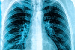 X Ray Chest Lungs 400b