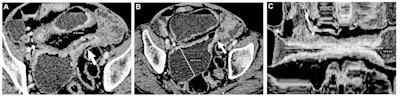 Contrast-enhanced CT enterography images of a Crohn's disease small bowel stricture in a 79-year-old male patient included in the study population. (A, B) Axial images show the presence of a long stricture (arrow) with a maximal stricture wall thickness of 6.8 mm (line in A) and marked maximal associated small bowel dilation (60.3 mm; line in B). (C) Curvilinear multiplanar reconstruction focused on the same small bowel stricture allows measurement of the total length of the stricture (10.2 cm). Images and caption courtesy of the RSNA.