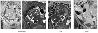 Coronal single-shot fast spin-echo and postgadolinium images demonstrate the proximal, mid, and distal aspects of a naive stricture at MR enterography performed in a 71-year-old female patient. There is a long inflammatory stricture with multifocal areas of luminal narrowing and intervening areas of active inflammation involving the terminal ileum. The four central readers measured this stricture as being 70.1 cm, 69.8 cm, 71.7 cm, and 71.6 cm in length … The arrows point to a single stricture that was assessed by all readers. Colored dots in the left-most and right-most images are reader markings along the lumen of the stricture. Postgadolinium images are the middle images. Images and caption courtesy of the RSNA.