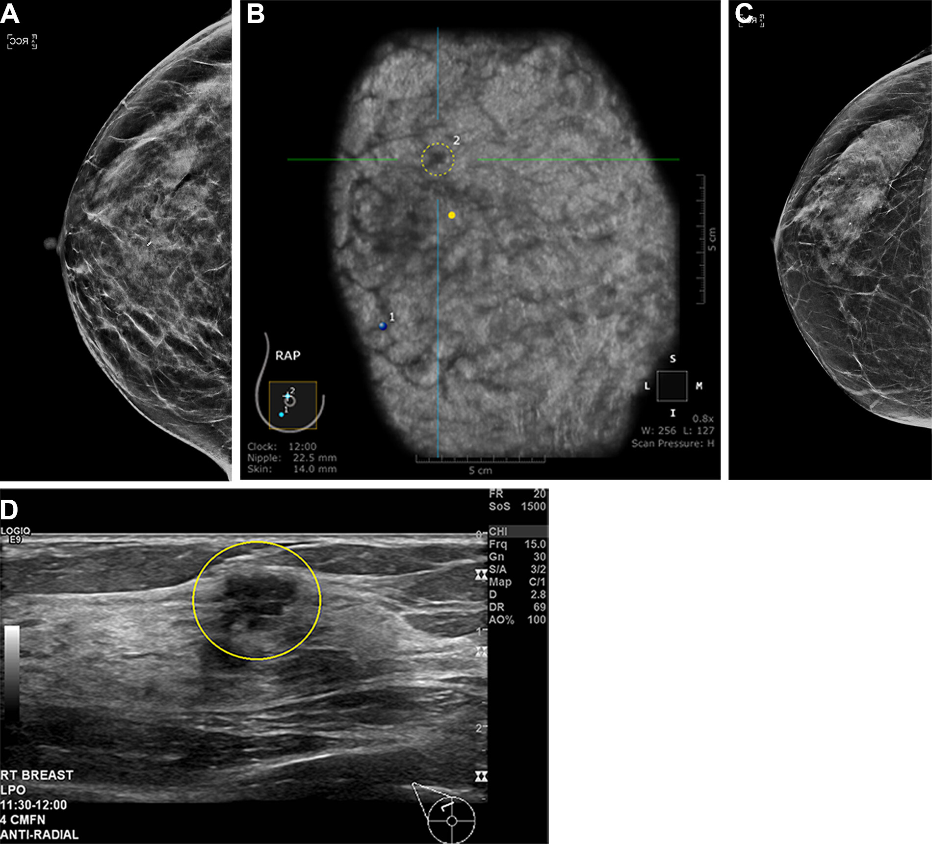 Sample images show cancer detection at supplemental ultrasound screening after screening mammography with a negative result. (A) Craniocaudal right breast screening mammography shows negative findings in a 54-year-old female patient with extremely dense breast tissue. (B) Coronal view from supplemental screening with automated whole-breast ultrasound image in the same patient four months later shows an irregular hypoechoic mass (dashed yellow circle) in the right breast, diagnosed as invasive ductal carcinoma. (C) Craniocaudal screening right breast mammography shows negative findings in a 74-year-old patient with heterogeneously dense breast tissue. (D) Antiradial gray-scale image in the right breast from supplemental handheld screening ultrasound in the same 74-year-old patient 7 months later demonstrates an irregular hypoechoic mass in the right breast (yellow outline), which yielded a diagnosis of invasive ductal carcinoma. Image courtesy of the RSNA.