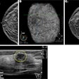 Sample images show cancer detection at supplemental ultrasound screening after screening mammography with a negative result. (A) Craniocaudal right breast screening mammography shows negative findings in a 54-year-old female patient with extremely dense breast tissue. (B) Coronal view from supplemental screening with automated whole-breast ultrasound image in the same patient four months later shows an irregular hypoechoic mass (dashed yellow circle) in the right breast, diagnosed as invasive ductal carcinoma. (C) Craniocaudal screening right breast mammography shows negative findings in a 74-year-old patient with heterogeneously dense breast tissue. (D) Antiradial gray-scale image in the right breast from supplemental handheld screening ultrasound in the same 74-year-old patient 7 months later demonstrates an irregular hypoechoic mass in the right breast (yellow outline), which yielded a diagnosis of invasive ductal carcinoma. Image courtesy of the RSNA.