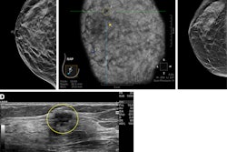 Sample images show cancer detection at supplemental ultrasound screening after screening mammography with a negative result. (A) Craniocaudal right breast screening mammography shows negative findings in a 54-year-old female patient with extremely dense breast tissue. (B) Coronal view from supplemental screening with automated whole-breast ultrasound image in the same patient four months later shows an irregular hypoechoic mass (dashed yellow circle) in the right breast, diagnosed as invasive ductal carcinoma. (C) Craniocaudal screening right breast mammography shows negative findings in a 74-year-old patient with heterogeneously dense breast tissue. (D) Antiradial gray-scale image in the right breast from supplemental handheld screening ultrasound in the same 74-year-old patient 7 months later demonstrates an irregular hypoechoic mass in the right breast (yellow outline), which yielded a diagnosis of invasive ductal carcinoma. Image courtesy of the RSNA.
