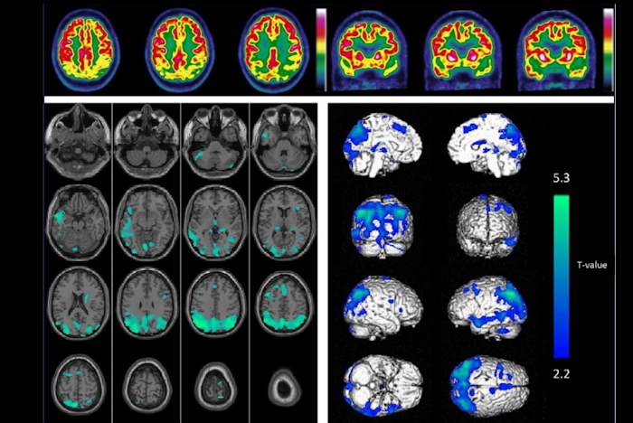2024 08 13 Alztherapy Fdg Pet Rules Out Ad Heyer Image