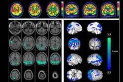 2024 08 13 Alztherapy Fdg Pet Rules Out Ad Heyer Image