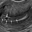 An intradecidual sign depicts transvaginal sagittal grayscale ultrasound imaging in a 34-year-old pregnant patient, which shows a 4-mm empty gestational sac (solid arrow) in the anterior endometrium. The location of the sac to one side of the central hyperechoic line (dotted arrows) representing the opposed innermost layers of decidualized endometrium confirms it is within the endometrium and not the endometrial cavity, hence the name intradecidual sign. This sign is helpful when seen to diagnose a probable intrauterine pregnancy before visualization of the yolk sac. Three days later, the yolk sac was visualized (not shown), allowing for the diagnosis of a definite intrauterine pregnancy.