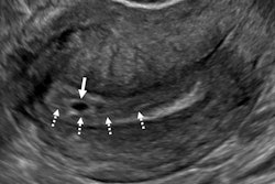 An intradecidual sign depicts transvaginal sagittal grayscale ultrasound imaging in a 34-year-old pregnant patient, which shows a 4-mm empty gestational sac (solid arrow) in the anterior endometrium. The location of the sac to one side of the central hyperechoic line (dotted arrows) representing the opposed innermost layers of decidualized endometrium confirms it is within the endometrium and not the endometrial cavity, hence the name intradecidual sign. This sign is helpful when seen to diagnose a probable intrauterine pregnancy before visualization of the yolk sac. Three days later, the yolk sac was visualized (not shown), allowing for the diagnosis of a definite intrauterine pregnancy.