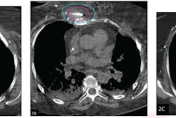 (A) Axial noncontrast CT chest image shows soft tissue mass in the anterior chest wall (arrow). The lesion was treated by percutaneous cryoablation. (B) Intraprocedural axial CT image obtained during cryoablation. The pink outline represents the target lesion and the blue outline represents ice ball. Based on review, the procedure was classified as achieving adequate ablation. (C) Axial contrast-enhanced CT chest image, obtained three months after ablation (patient’s first follow-up exam), shows involution of the target lesion without evidence of residue. Image courtesy of the ARRS.