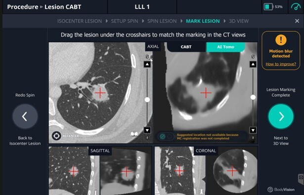 Updated Body Vision Medical AI Tomo with larger field of view. Image courtesy of Body Vision Medical.