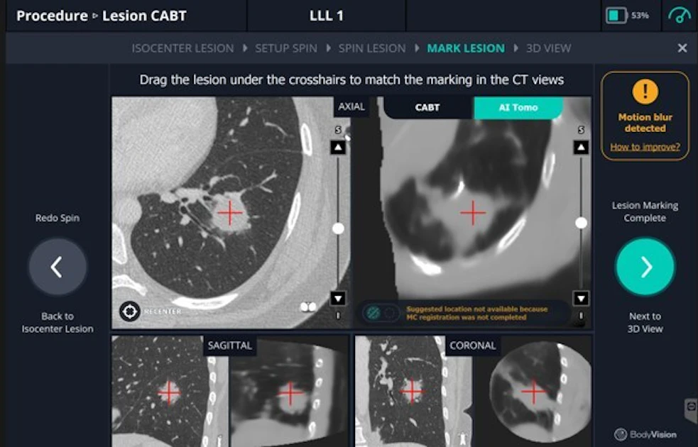 Body Vision Medical releases LungVision software update | AuntMinnie