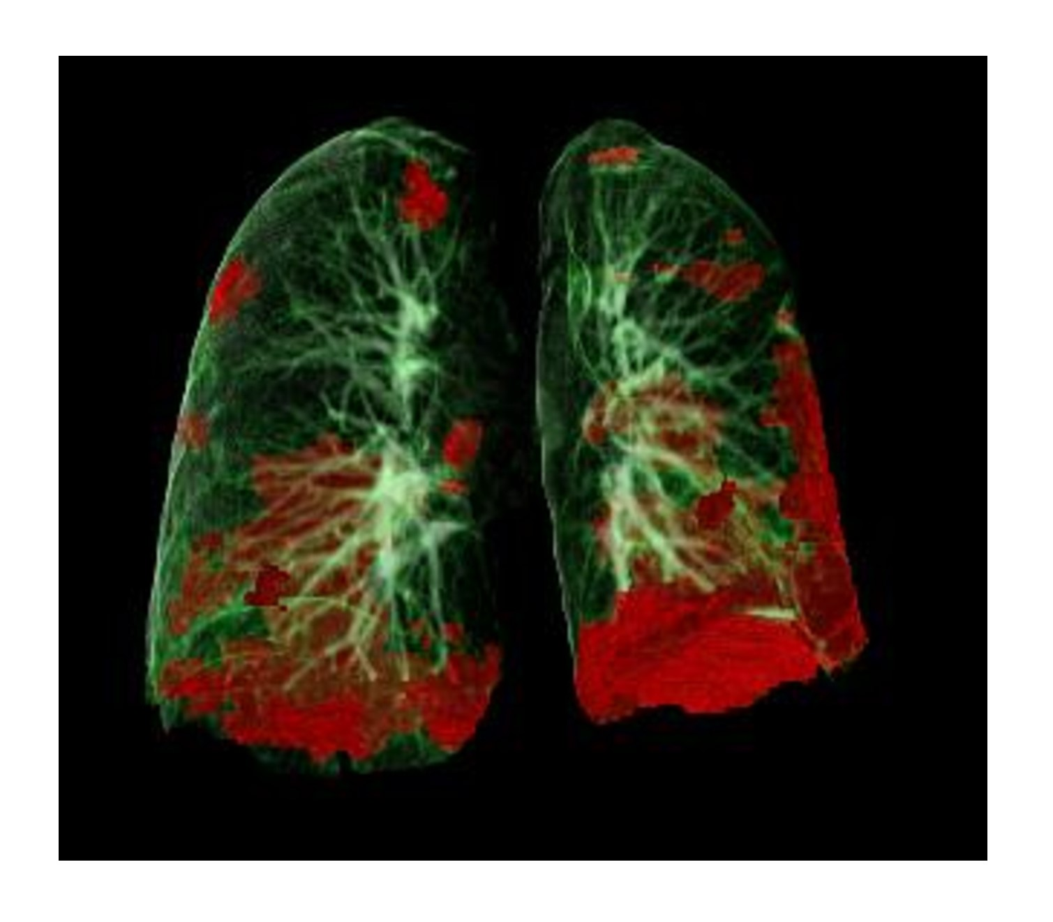 Ct Lung Damage Covid