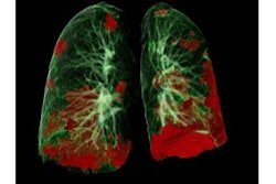 Ct Lung Damage Covid