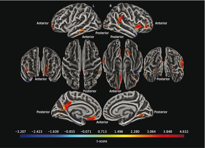 Pittsburgh Compound B (PiB) PET distribution volume ratio (DVR) images were projected onto fsaverage surfaces from FreeSurfer and surface smoothed, with PiB (amyloid) slope maps created using ordinary least squares regression (time as only factor) and mixed effects models for 154 participants run at each vertex (P < .01; model: longitudinal Geriatric Depression Scale score estimated by amyloid slope &times; time + [sex + education + age] &times; time). This map visualizes the results of the linear mixed-effects models (t score of the main variable, amyloid slope &times; time) such that regions with a greater t score (red) represent areas in which greater depressive symptoms are associated with greater amyloid accumulation (amyloid slope). Anatomical landmarks are provided: L refers to the left hemisphere, R refers to the right hemisphere, and additional labels indicate the anterior and posterior ends of the brain. Images available for republishing under Creative Commons license (CC BY 4.0 DEED, Attribution 4.0 International) and courtesy of JAMA Open Network.