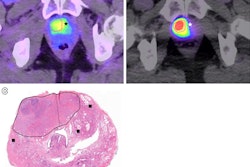 Dynamic PET/CT and pathologic images for a 66-year-old male participant. (A) Axial dynamic PET/CT image acquired during intravenous administration of Ga-68 PSMA-11 demonstrates the hypermetabolic primary prostatic tumor. The right-sided portion of the lesion used for volume of interest (VOI) analysis is outlined in pink, reflecting the margins seen on a prior T2-weighted MRI scan. Tumor radiotracer uptake extends across midline into the left anterior apex (*). (B) Axial dynamic PET/CT image acquired during selective right prostatic arterial administration of Ga-68 PSMA-11 demonstrates intense radiotracer uptake in the VOI outlined in pink. There is comparatively minimal uptake in the unperfused left-sided portion of the tumor (*). The arterial sheath and catheters in the right groin are partially visualized (arrow). (C) Photomicrograph (hematoxylin-eosin stain; unmagnified) of the prostatic apex after radical prostatectomy. The midline (dotted line) and dominant tumor margins (solid line) are shown. Small additional areas of carcinoma (■) without T2-weighted MRI correlates were also identified at pathologic examination.
