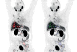 Whole-body anterior coronal PSMA-PET maximum intensity projection images in a 63-year-old white male participant with tumors in the liver, bone, and lymph node (LN) who had an initial prostate-specific antigen level of 181.9 ng/mL and Eastern Cooperative Oncology Group performance score of 0/1. The images show all PSMA-positive (PSMA+) disease as a single whole-body volume in red (left) and segmented according to anatomic region (right; bone lesions in blue, liver lesions in green, lymph node lesions in red).