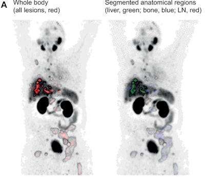 Whole-body anterior coronal PSMA-PET maximum intensity projection images in a 63-year-old white male participant with tumors in the liver, bone, and lymph node (LN) who had an initial prostate-specific antigen level of 181.9 ng/mL and Eastern Cooperative Oncology Group performance score of 0/1. The images show all PSMA-positive (PSMA+) disease as a single whole-body volume in red (left) and segmented according to anatomic region (right; bone lesions in blue, liver lesions in green, lymph node lesions in red).