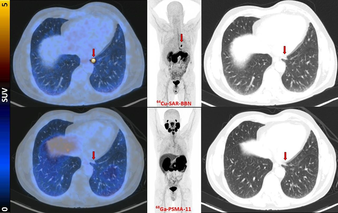 Fused PET/CT, maximum-intensity projection PET, and lung-windowed CT images (from left to right) from Cu-64 SAR-BBN (top row) and Ga-68 PSMA-11 (bottom row) PET/CT study of patient demonstrating left subpleural lesion (arrows, SUVmax of 10 at 1 hour) that showed Cu-64 SAR-BBN uptake but no Ga-68 PSMA-11 uptake. PSA was 1.84 ng/mL at time of imaging. This patient underwent lobectomy, with histopathology demonstrating metastatic prostate cancer.