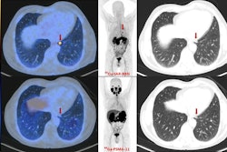 Fused PET/CT, maximum-intensity projection PET, and lung-windowed CT images (from left to right) from Cu-64 SAR-BBN (top row) and Ga-68 PSMA-11 (bottom row) PET/CT study of patient demonstrating left subpleural lesion (arrows, SUVmax of 10 at 1 hour) that showed Cu-64 SAR-BBN uptake but no Ga-68 PSMA-11 uptake. PSA was 1.84 ng/mL at time of imaging. This patient underwent lobectomy, with histopathology demonstrating metastatic prostate cancer.