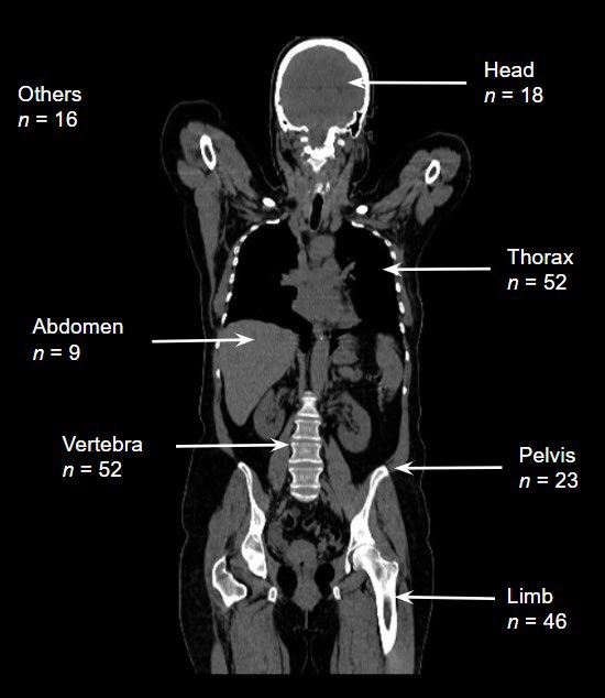 The number of patients affected by region. Images available for republishing under Creative Commons license (CC BY 4.0 DEED, Attribution 4.0 International) and courtesy of Tomography.