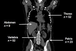 The number of patients affected by region. Images available for republishing under Creative Commons license (CC BY 4.0 DEED, Attribution 4.0 International) and courtesy of Tomography.