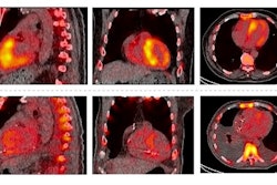 Sagittal, coronal, and axial fused Tc-99m PYP-SPECT/CT images of a 93-year-old male at baseline and after two years of tafamidis 61 mg daily by mouth therapy. Tc-99m PYP images are shown in color and CT images are shown in grey scale. These images show a reduction in visual grade from an initial grade of 3 (myocardial uptake > rib uptake) to a follow-up grade of 1 (myocardial uptake < rib uptake). Quantitative metrics decreased significantly as well.