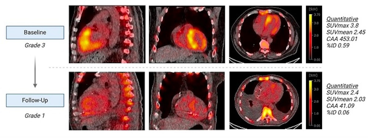 SPECT/CT visualizes heart’s response to tafamidis | AuntMinnie
