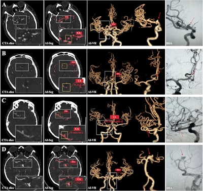 Original axial CT angiography (CTA) section, vessel, and cerebral aneurysm (CA) segmentation of the AI model (AI-Seg), volume rendering derived from the AI-segmented results (AI-VR), and digital subtraction angiography (DSA) images verified at various locations and sizes for cerebral aneurysm diagnosis. CTA images were acquired in the transverse plane, with the contrast agent (comprising 60 mL of iohexol [350 mg of iodine per milliliter] and 40 mL of normal saline at an injection rate of 5 mL/sec) administered using the smart tracking method. (A) In a 66-year-old male patient, the cerebral aneurysm was diagnosed by the deep-learning (DL) model in the right internal carotid artery segment C7 (R-ICA-C7) (boxes and red label), with verification at DSA (arrow), and the short and long diameter description was “3.2 × 5.1 mm.” (B) In a 68-year-old male patient, the cerebral aneurysm was diagnosed by the DL model in the right anterior cerebral artery segment A2 (R-ACA-A2), with verification at DSA, and the short and long diameter description was “3.3 × 6.5 mm.” (C) In a 57-year-old female patient, the cerebral aneurysm was diagnosed by the DL model in the right middle cerebral artery M2 bifurcation (R-MCA-M2), with verification at DSA, and the short and long diameter description was “3 × 3 mm.” (D) In a 65-year-old female patient, the cerebral aneurysm was diagnosed by the DL model in the left posterior cerebral artery segment P1 (L-PCA-P1), with verification at DSA, and the short and long diameter description was “4.5 × 7.1 mm.” Images and caption courtesy of Radiology.