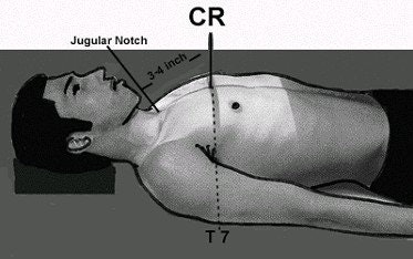 For an AP chest radiograph, the landmark used for positioning the central ray (CR) is at T7 (mid-thorax). The level of T7 is 3-4 inches (8-10 cm) below the jugular notch. Image courtesy of Dr. Naveed Ahmad. Reprinted from Merrill’s Atlas of Radiographic Positions and Radiologic Procedures, 9th edition, Ballinger and Frank, page 58 (figure 10-52), copyright 1999 Mosby, with permission from Elsevier Science.