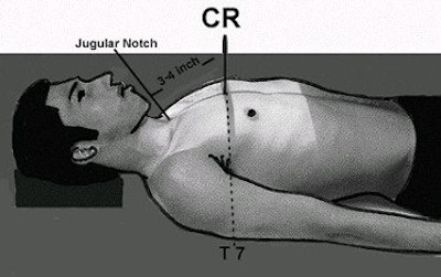 For an AP chest radiograph, the landmark used for positioning the central ray (CR) is at T7 (mid-thorax). The level of T7 is 3-4 inches (8-10 cm) below the jugular notch. Image courtesy of Dr. Naveed Ahmad. Reprinted from Merrill’s Atlas of Radiographic Positions and Radiologic Procedures, 9th edition, Ballinger and Frank, page 58 (figure 10-52), copyright 1999 Mosby, with permission from Elsevier Science.