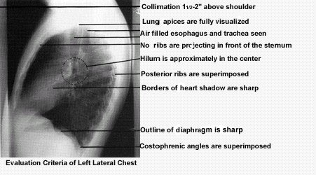 Mastering AP and lateral positioning for chest x-ray | AuntMinnie