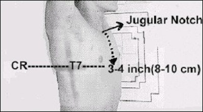 For a lateral projection chest radiograph, the landmark used for locating the center of lung fields is at T7 (mid-thorax). The level of T7 on an average adult is 3-4 inches (8-10 cm) below the jugular notch. Image courtesy of Dr. Naveed Ahmad. Reprinted from Merrill’s Atlas of Radiographic Positions and Radiologic Procedures, 9th edition, Ballinger and Frank, page 550 (figure 10-72), copyright 1999 Mosby, with permission from Elsevier Science.