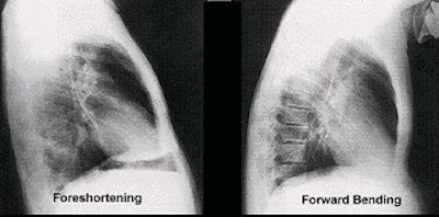 If the patient is leaning against the grid device (foreshortening) or forward bending, there is distortion of all thoracic structures. Image courtesy of Dr. Naveed Ahmad.