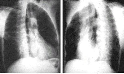 A right anterior oblique (right image) and left anterior oblique (left image) view demonstrate maximum area of the lung field. Image courtesy of Dr. Naveed Ahmad.