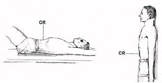 Standard AP supine and upright abdominal patient position. Image courtesy of Dr. Naveed Ahmad.
