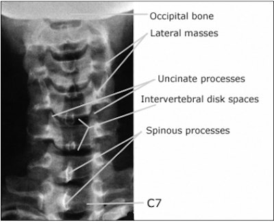 An AP axial cervical spine radiograph. Note that this projection demonstrates the C-3 through C-7 vertebral bodies and the intervertebral spaces. The spinous processes are seen superimposed on the bodies resembling teardrops. The C-1 and C-2 vertebrae are not adequately seen. Image courtesy of Dr. Naveed Ahmad.