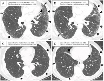 Representative CT scans assessed as having interstitial lung abnormality according to ground-truth labeling in the test set. (A, B) Axial CT images in a patient assigned a probability of 1.00 by the case inference model. The sections show ground-glass abnormality in the subpleural area of the bilateral lungs (arrows) and traction bronchiectasis in the lingula of the left lung (arrowhead in A). (C, D) Axial CT images in a patient assigned a probability of 0.53 by the case inference model. (C) Slight ground-glass abnormality is seen in the subpleural area of the bilateral lungs (arrows), and the probability assigned by the section inference model is moderate (0.49). (D) At the lower section level, ground-glass abnormality is more widespread (arrows), and the probability assigned by the section inference model is higher (0.89). The probabilities were calculated with the model using the three-label method in the section inference model and the two-label method and random forest classifier in the case inference model. Images and caption courtesy of the RSNA.
