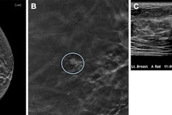 Images depict a 67-year-old woman who was recalled from screening for a small focal asymmetry in the left breast. (A) 2D mammographic image shows the lesion (arrow), which is difficult to see. (B) The digital breast tomosynthesis section image shows spiculated margins (circle). (C) The ultrasound image shows a corresponding irregular hypoechoic mass with angular margins. Pathologic evaluation revealed a 0.7-cm triple-negative invasive carcinoma. Image courtesy of RSNA.