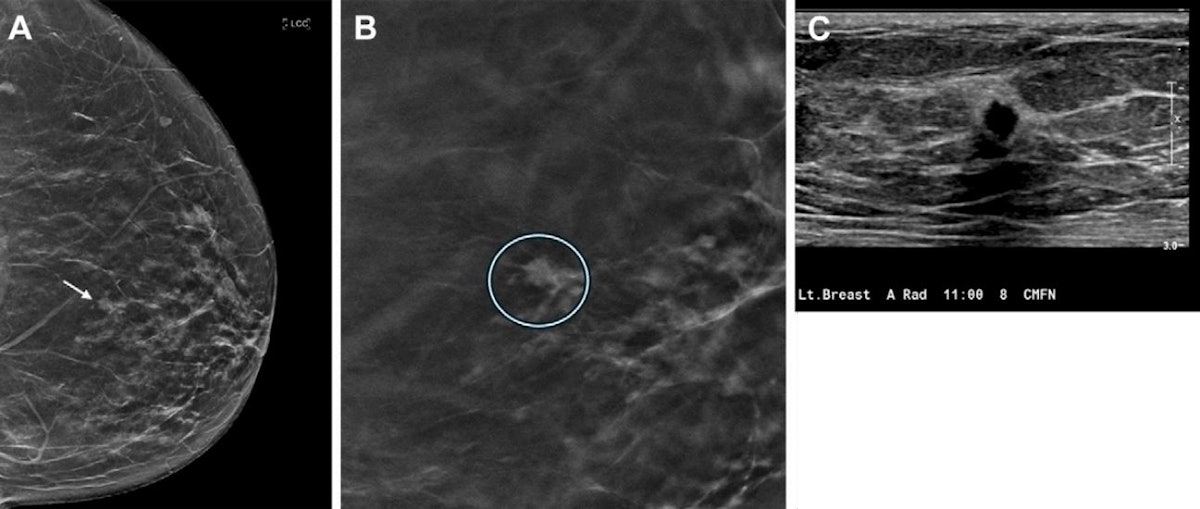 健康・医学 Breast Cancer DBT increases cancer detection over 10-year period | AuntMinnie