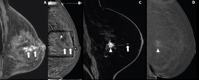 (A, B) Images depict a 65-year-old woman with prior left malignant lumpectomy. (A) Sagittal fat-suppressed contrast-enhanced T1-weighted image from diagnostic MRI performed for clear left nipple discharge shows segmental nonmass enhancement (NME) (arrows), deemed suspicious with assessment as BI-RADS category 4. The patient elected to undergo attempted contrast-enhanced mammography (CEM)-guided biopsy rather than direct MRI-guided biopsy. (B) Recombined scout image from attempted CEM-guided biopsy shows corresponding NME (arrows), serving as the biopsy target. CEM-guided biopsy was completed. Histologic assessment yielded benign findings, deemed concordant by the performing radiologist. (C,D) Images depict a 55-year-old woman with left breast invasive ductal carcinoma (IDC). (C) Sagittal fat-suppressed contrast-enhanced T1-weighted MR image from staging MRI shows known IDC (arrowhead) and additional 4-mm NME (arrow), deemed suspicious with assessment as BI-RADS category 4. Only NME was considered to represent a suspicious finding warranting biopsy. The patient elected to undergo attempted CEM-guided biopsy rather than direct MRI-guided biopsy. (D) Recombined scout image from attempted CEM-guided biopsy shows an enhancement of known IDC (arrowhead). Suspicious NME is not visualized. Given the absence of a CEM correlate to serve as biopsy target, CEM-guided biopsy was canceled. Subsequent MRI-guided biopsy of suspicious NME was completed; histologic assessment yielded IDC, deemed concordant by the performing radiologist. Image courtesy of the ARRS.