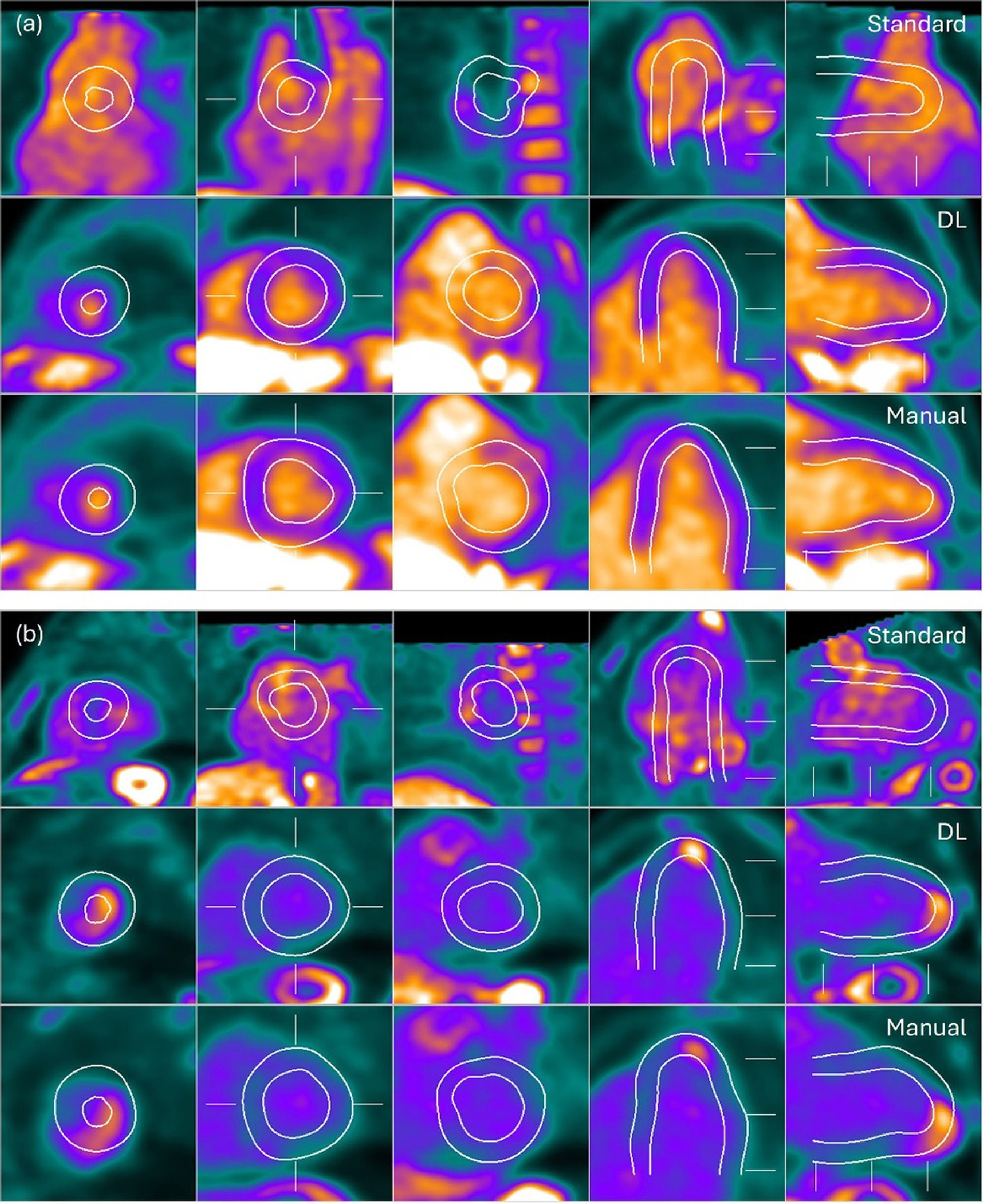 Examples of the standard myocardial perfusion imaging (MPI) segmentation, DL segmentation, and manual segmentation for negative (a) and positive (b) FDG-PET studies. Image courtesy of the American Society of Nuclear Cardiology.