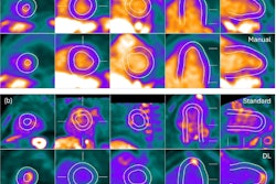 Examples of the standard myocardial perfusion imaging (MPI) segmentation, DL segmentation, and manual segmentation for negative (a) and positive (b) FDG-PET studies. Image courtesy of the American Society of Nuclear Cardiology.