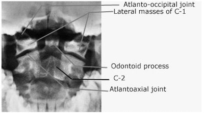 Open-mouth radiograph of the cervical spine. On this radiograph, the odontoid process, the body of C-2, and lateral masses of the atlas are well demonstrated. The atlantoaxial joints are seen to best advantage. Image courtesy of Dr. Naveed Ahmad.