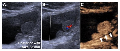 Contrast-enhanced ultrasound (CEUS) Vesical Imaging-Reporting and Data System (VI-RADS) category 3 findings in a 40-year-old male with non-muscle-invasive high-grade urothelial carcinoma. (A) Grayscale US image obtained using a convex array probe (5C1) through a transabdominal approach showed a 35-mm lesion at the bladder posterior wall. (B) Color Doppler US image showed inner vascularity within the lesion. (C) Contrast-enhanced US image showed well-defined continuous layer of hypo-enhanced muscularis propria (white arrows) without vascular stalk on contrast-enhanced US or early hyper-enhanced continuous inner layer. The observation was assigned to VI-RADS 3 based on contrast-enhanced US by the readers devising the CEUS VI-RADS. Image and caption courtesy of the RSNA.