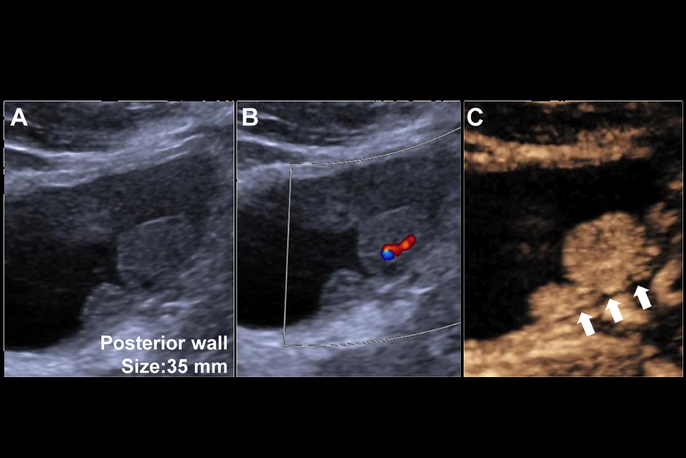 Ceus Vi Rads 09 10 2024 Rsna Thumbnail V2