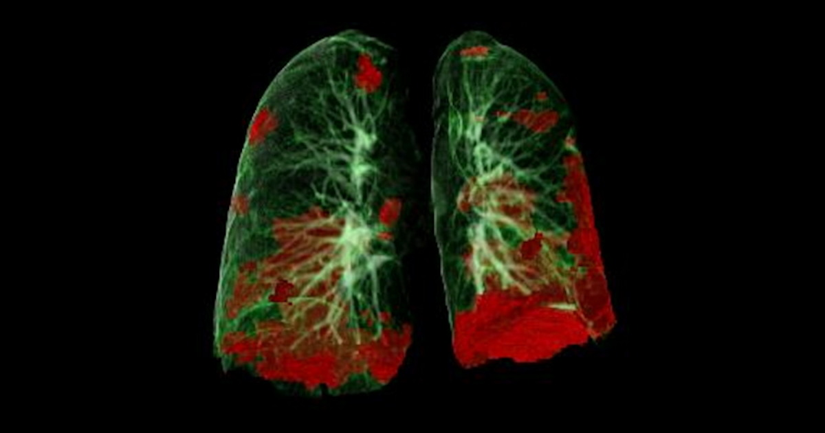 Ct Lung Damage Covid 19 Social