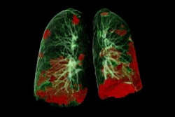 Ct Lung Damage Covid 19 Social
